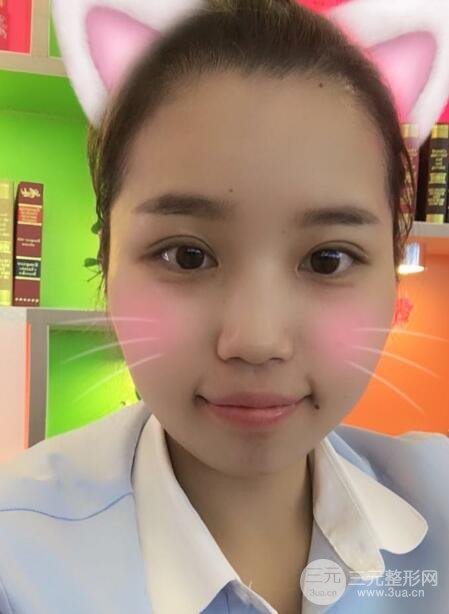 切開(kāi)雙眼皮無(wú)疤痕增生果圖案例