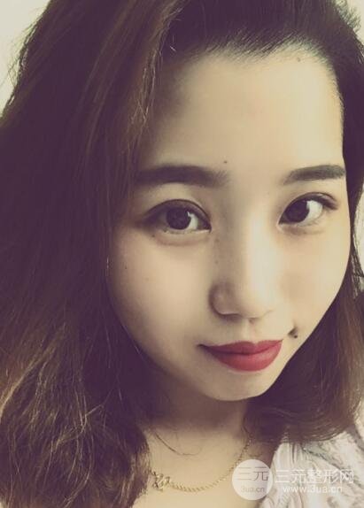 切開(kāi)雙眼皮無(wú)疤痕增生果圖案例