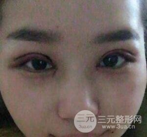 切開(kāi)雙眼皮無(wú)疤痕增生果圖案例