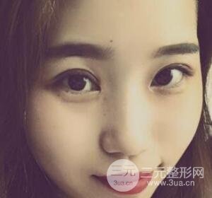 切開(kāi)雙眼皮無(wú)疤痕增生果圖案例