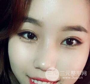 切開(kāi)雙眼皮無(wú)疤痕增生果圖案例