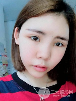 自體脂肪填充全臉真實案例——濟南愛容張慶國醫(yī)生做的