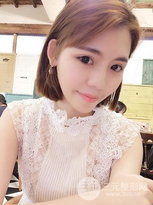 自體脂肪填充全臉真實案例——濟南愛容張慶國醫(yī)生做的