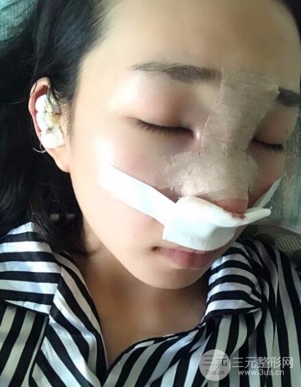 隆鼻整形價格和真人案例