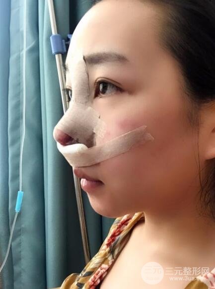 隆鼻整形價格和真人案例