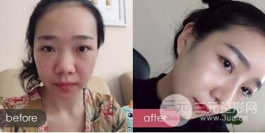 隆鼻整形價格和真人案例