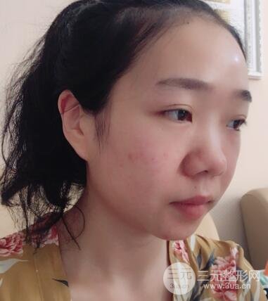 隆鼻整形價格和真人案例