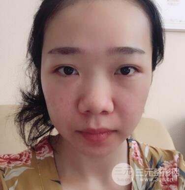 隆鼻整形價格和真人案例