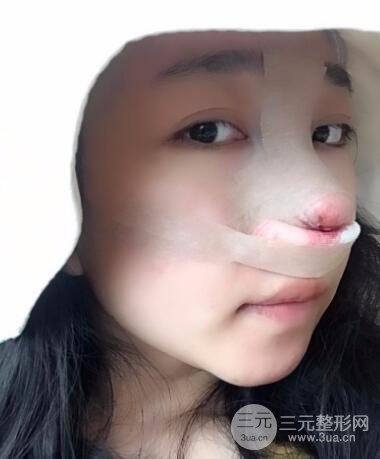 隆鼻整形價格和真人案例