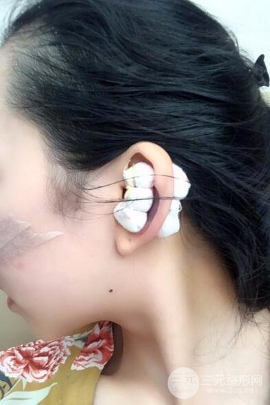 隆鼻整形價格和真人案例