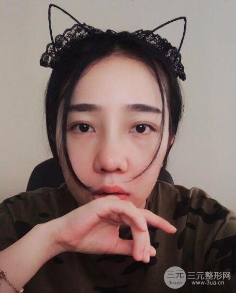 隆鼻整形價格和真人案例