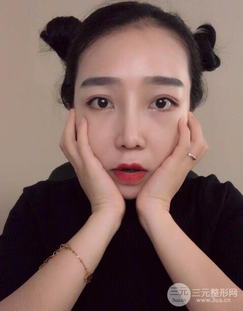 隆鼻整形價格和真人案例