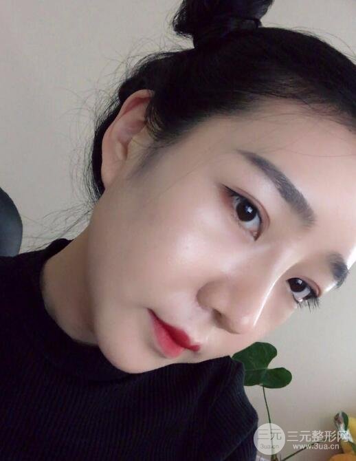 隆鼻整形價格和真人案例