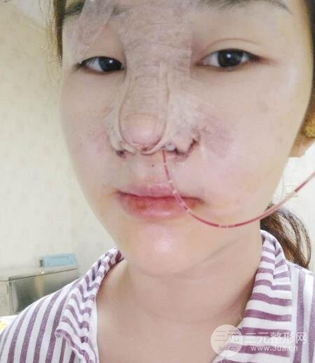 蒜頭鼻整形價格和對比照片案例