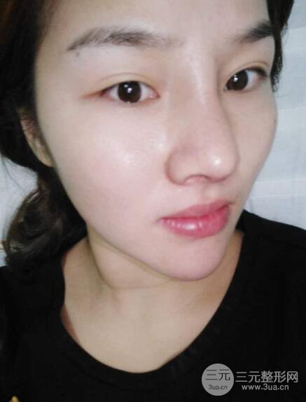 蒜頭鼻整形價格和對比照片案例