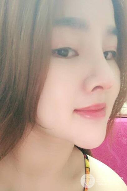 蒜頭鼻整形價格和對比照片案例