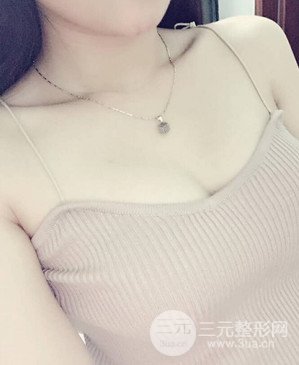 濟南海峽趙廣生自體脂肪隆胸真實案例附上前后對比圖