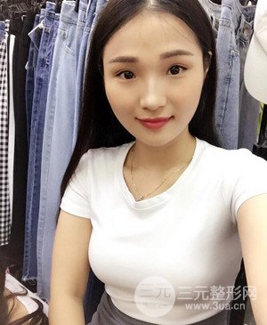 濟南海峽趙廣生自體脂肪隆胸真實案例附上前后對比圖