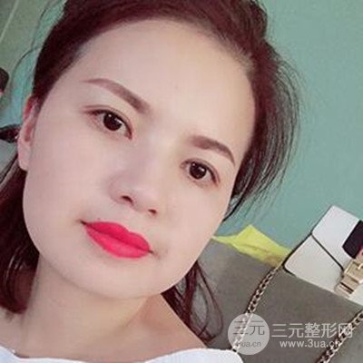 濟(jì)南海峽謝燕燕做的雙眼皮多項(xiàng)整形整形手術(shù)，分享一下前后對(duì)比圖