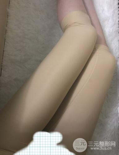 大腿環(huán)吸抽脂價(jià)格和圖片案例