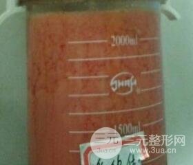 大腿環(huán)吸抽脂價(jià)格和圖片案例