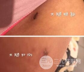 大腿環(huán)吸抽脂價(jià)格和圖片案例