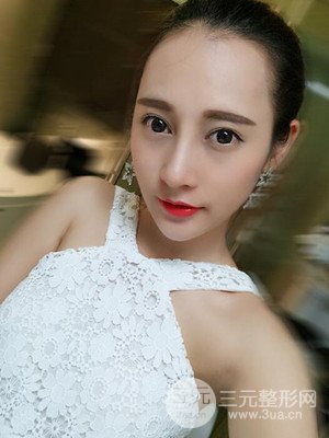 隆鼻失敗修復(fù)手術(shù)真實(shí)案例以及前后對(duì)比圖——青海康華馮相周醫(yī)生做的