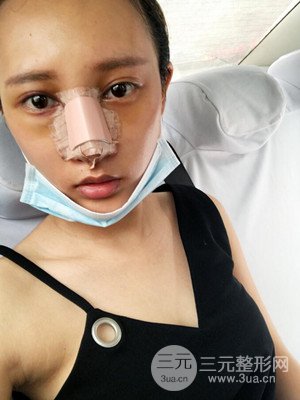 隆鼻失敗修復(fù)手術(shù)真實(shí)案例以及前后對(duì)比圖——青?？等A馮相周醫(yī)生做的