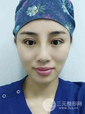 青海康華馬晶醫(yī)生給我做的硅膠假體隆鼻+雙眼皮手術(shù)，分享一下前后對(duì)比圖