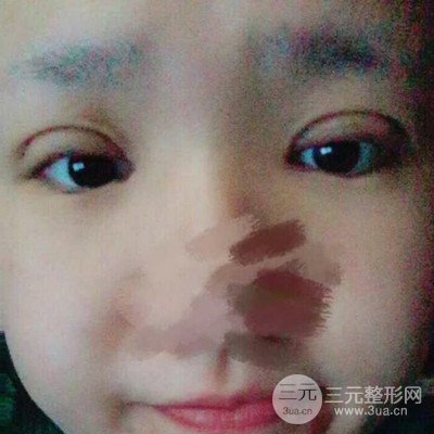 汕頭愛麗諾蘇國藝給我做的雙眼皮手術(shù)，把前后的對比圖片分享給大家