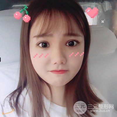 汕頭愛麗諾蘇國藝給我做的雙眼皮手術(shù)，把前后的對比圖片分享給大家