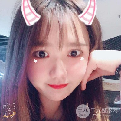 汕頭愛麗諾蘇國藝給我做的雙眼皮手術(shù)，把前后的對比圖片分享給大家