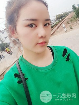 硅膠假體墊下巴真實案例，汕頭愛麗諾蘇國藝做的