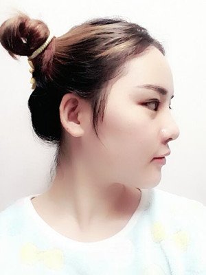 硅膠假體墊下巴真實案例，汕頭愛麗諾蘇國藝做的