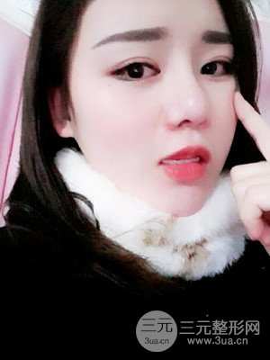 硅膠假體墊下巴真實案例，汕頭愛麗諾蘇國藝做的