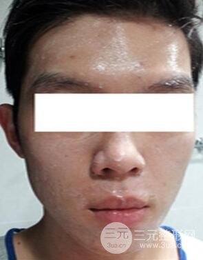 汕頭愛麗諾時慧醫(yī)生給我做的祛痘，看看前后果如何