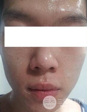 汕頭愛麗諾時慧醫(yī)生給我做的祛痘，看看前后果如何