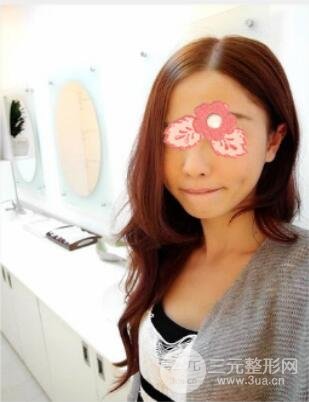 埋埋蛋白線.提升真實案例分享：汕頭愛麗諾時慧醫(yī)生做的