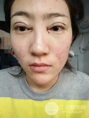 雙眼皮修復+開內(nèi)眼角真實案例附上前后對比圖片——汕頭伊麗莎白張紅軍做的