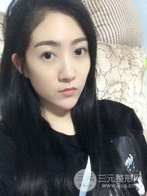 雙眼皮修復+開內(nèi)眼角真實案例附上前后對比圖片——汕頭伊麗莎白張紅軍做的