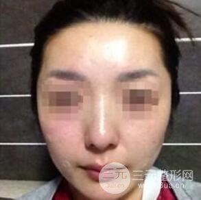 汕頭伊麗莎白張紅軍給我打的B****，分享一下前后照片