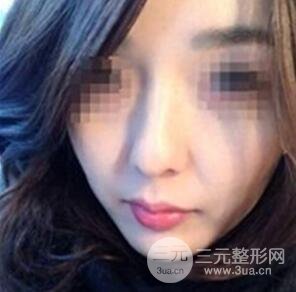 汕頭伊麗莎白張紅軍給我打的B****，分享一下前后照片