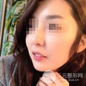 汕頭伊麗莎白張紅軍給我打的B****，分享一下前后照片