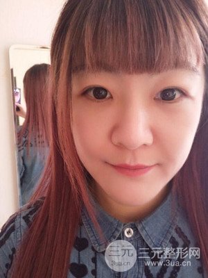 做了自體脂肪填充全臉日記分享——汕頭伊麗莎白孫杰醫(yī)生做的