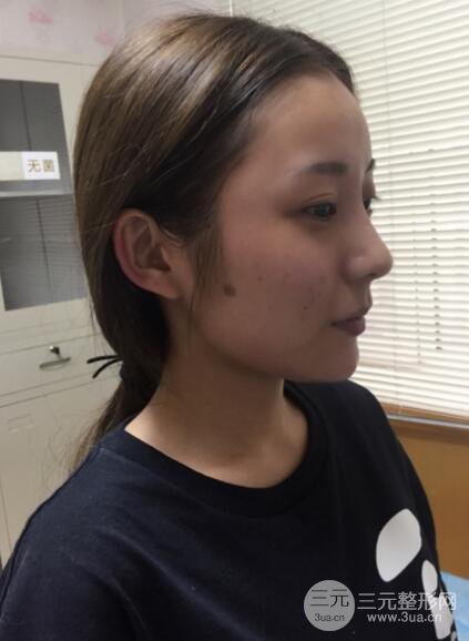 注射玻尿酸注射除皺緊致肌膚前后對(duì)比圖案例