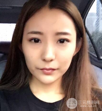 注射玻尿酸注射除皺緊致肌膚前后對(duì)比圖案例