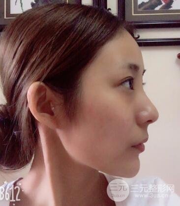 注射玻尿酸注射除皺緊致肌膚前后對(duì)比圖案例