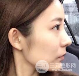 注射玻尿酸注射除皺緊致肌膚前后對比圖案例