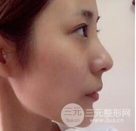 注射玻尿酸注射除皺緊致肌膚前后對比圖案例