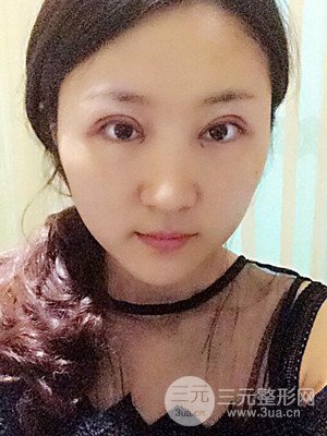 汕頭伊麗莎白孫杰醫(yī)生給我做的切開雙眼皮手術(shù)，分享一下前后對比圖片